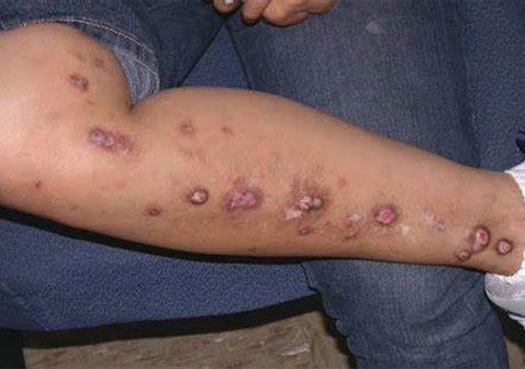 结节性痒疹图片