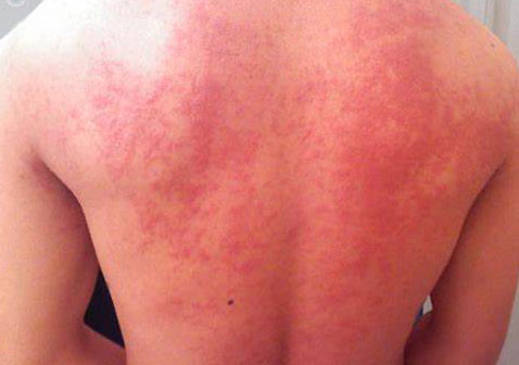 酒湿疹症状图片