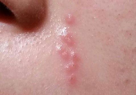 脸上起小水泡图片