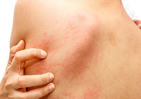 沐浴液过敏疙瘩图片