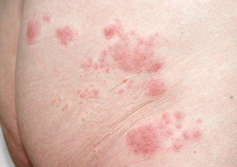 屁股发红起泡泡图片