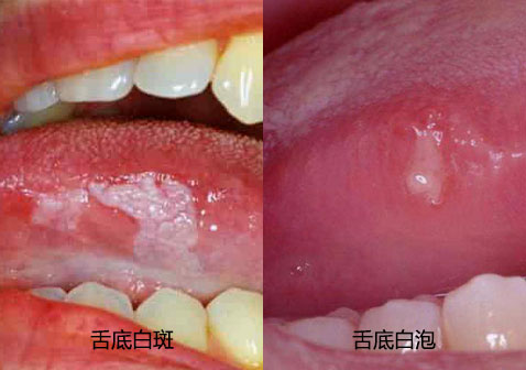 舌底白斑与白泡图片对比