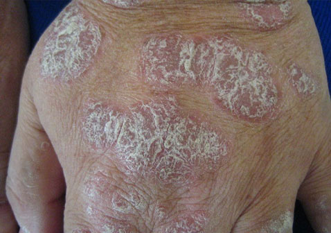 寻常型银屑病图片