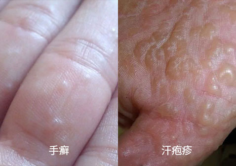 手癣和汗疱疹区别图片