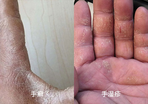 手癣和手湿疹的区别图片