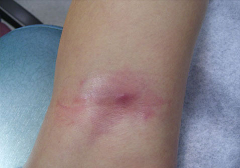 膝盖后面瘙痒有红疙瘩图片