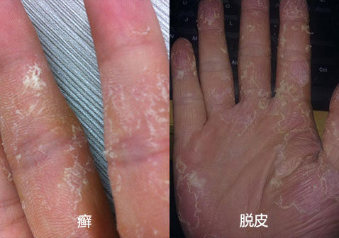 癣和脱皮的图片对比