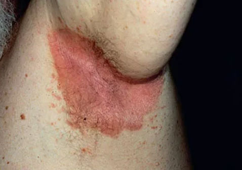 腋窝牛皮癣图片