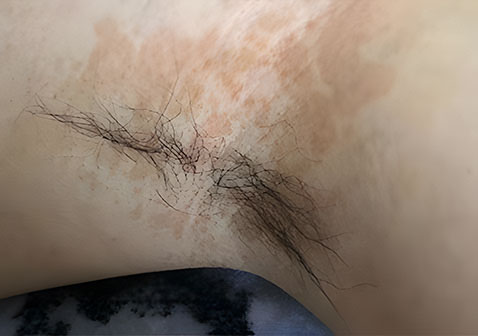 腋下花斑癣图片