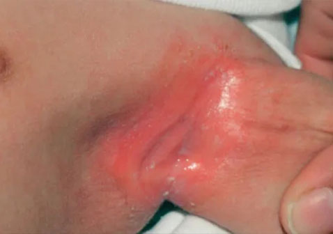 腋下间擦皮炎图片