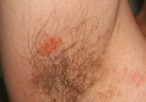 腋下玫瑰糠疹图片