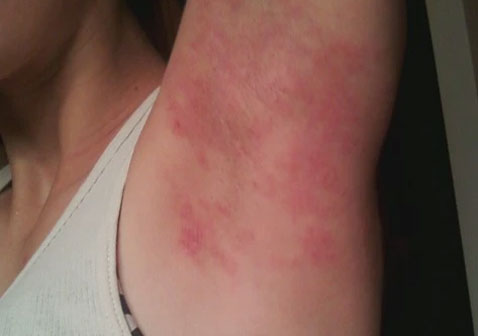 腋下湿疹图片