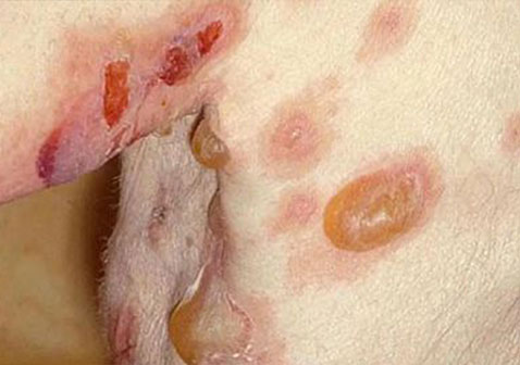 腋下天疱疮图片