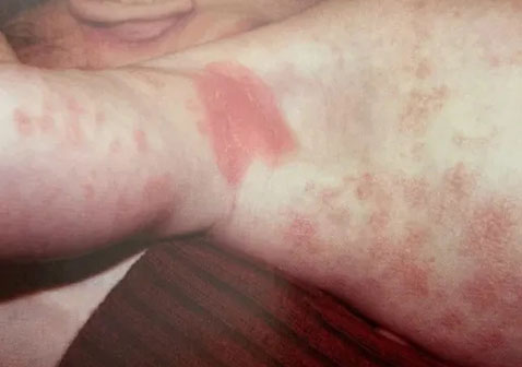 腋下脂溢性皮炎图片