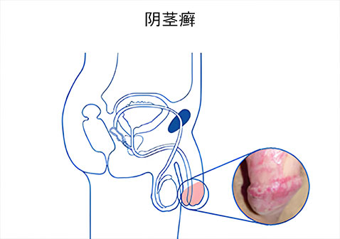 阴茎局部起癣图片