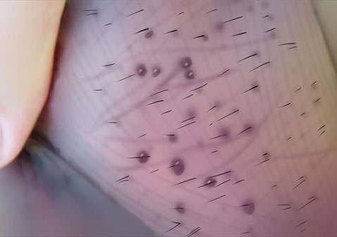 阴囊白色疙瘩图片