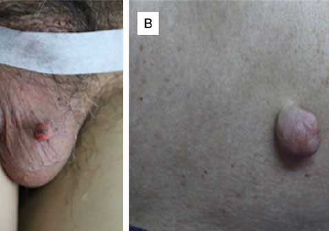 沐浴液过敏疙瘩图片